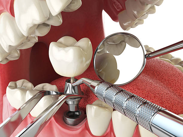 Best Knocked-Out Tooth (Avulsed Tooth) Treatment in Alma, AR